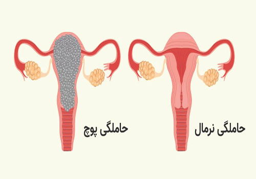 جلوگیری از بارداری پوچ با طب سنتی